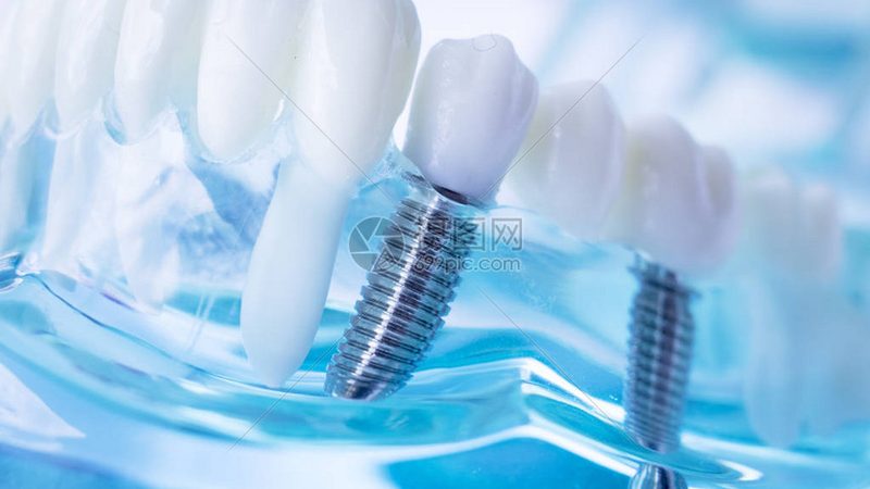 在前往医院补牙之前，需要准备好以下材料：